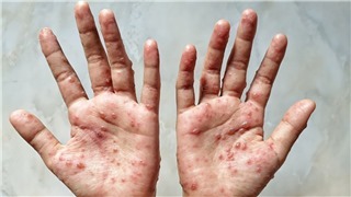  WHO xem xét khả năng ban bố tình trạng khẩn cấp y tế toàn cầu đối với bệnh đậu mùa khỉ 