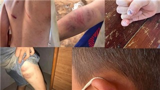  Vụ việc cháu bé 9 tuổi bị đánh đập ở Đắk Lắk: Khởi tố bà nội và cha ruột cháu bé 