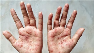  Bệnh nhân đậu mùa khỉ có thể không có triệu chứng 