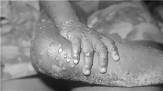  WHO quan ngại về quy mô và mức độ lây lan của virus đậu mùa khỉ  