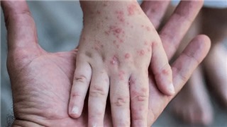  WHO chưa coi đậu mùa khỉ là tình trạng khẩn cấp y tế toàn cầu 