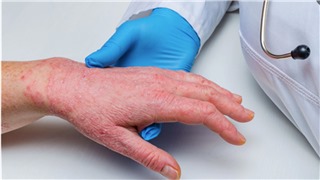  Thế giới nâng cao cảnh giác với bệnh đậu mùa khỉ 