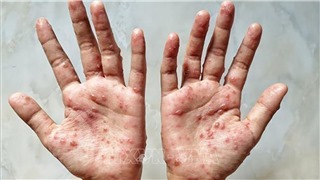  Bộ Y tế ban hành hướng dẫn chẩn đoán, điều trị và phòng bệnh đậu mùa khỉ ở người 